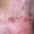 Красный плоский лишай (красный дерматит) – причины, симптомы и проявления на коже, на слизистых оболочках полости рта и половых органов (фото), диагностика. Эффективное лечение у взрослого человека, у детей