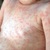 Розеола – симптомы у детей и взрослых (высокая температура, пятна на коже), диагностика и лечение. Отличия розеолы от краснухи. Фото сыпи на теле у ребенка