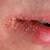 Заеды и трещины в уголках рта (ангулит, ангулярный хейлит, ангулярный стоматит). Причины, виды, симптомы и лечение заед на губах у ребенка, у взрослых
